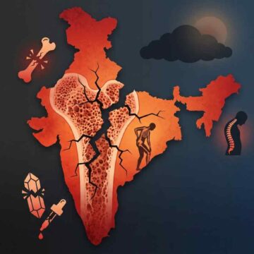 India's Silent Epidemic – The Deepening Calcium and Vitamin D Crisis-Wisekhabar India's Silent Epidemic – The Deepening Calcium and Vitamin D Crisis